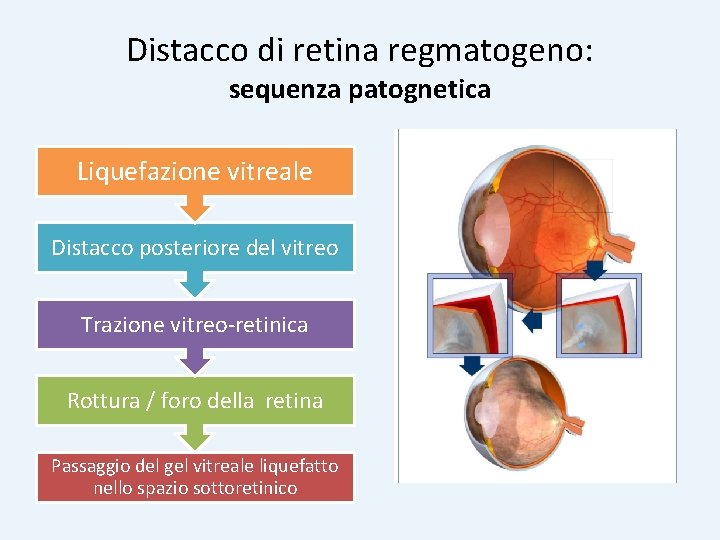 Distacco di retina regmatogeno: sequenza patognetica Liquefazione vitreale Distacco posteriore del vitreo Trazione vitreo-retinica