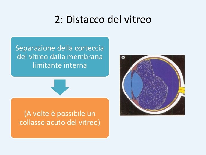 2: Distacco del vitreo Separazione della corteccia del vitreo dalla membrana limitante interna (A