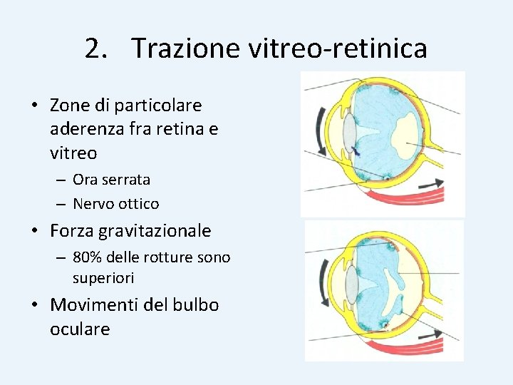 2. Trazione vitreo-retinica • Zone di particolare aderenza fra retina e vitreo – Ora