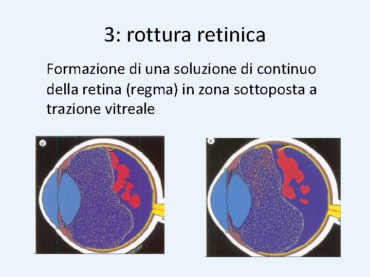3: rottura retinica Formazione di una soluzione di continuo della retina (regma) in zona