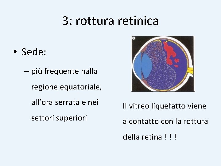 3: rottura retinica • Sede: – più frequente nalla regione equatoriale, all’ora serrata e