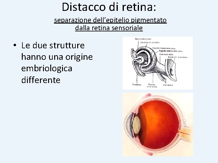 Distacco di retina: separazione dell’epitelio pigmentato dalla retina sensoriale • Le due strutture hanno