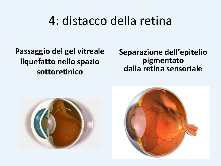 4: distacco della retina Passaggio del gel vitreale liquefatto nello spazio sottoretinico Separazione dell’epitelio