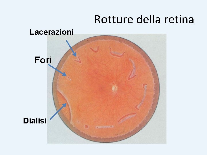 Rotture della retina Lacerazioni Fori Dialisi 