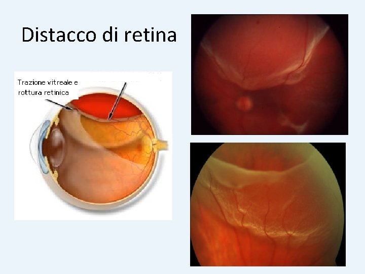 Distacco di retina 