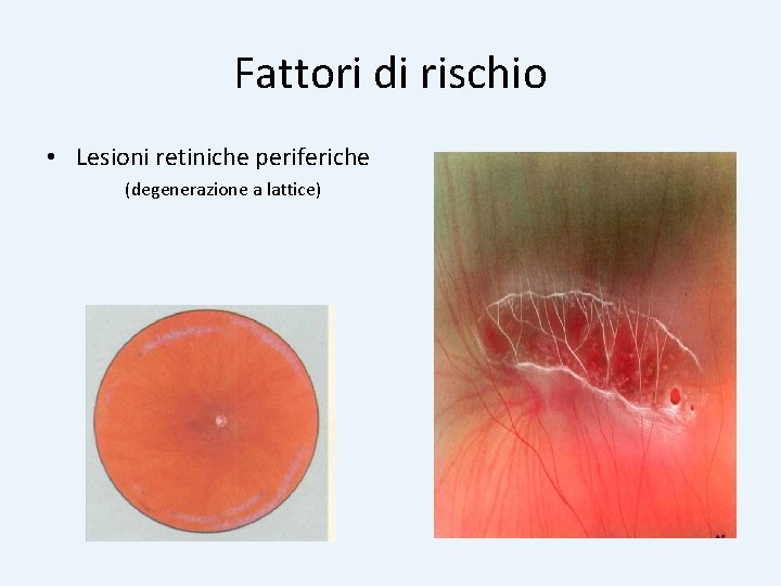 Fattori di rischio • Lesioni retiniche periferiche (degenerazione a lattice) 