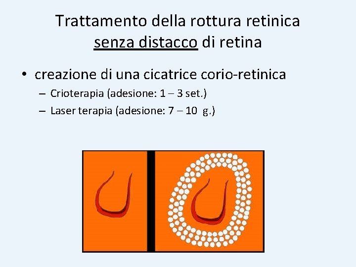 Trattamento della rottura retinica senza distacco di retina • creazione di una cicatrice corio-retinica