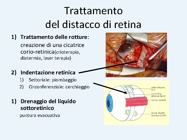 Trattamento del distacco di retina 1) Trattamento delle rotture: creazione di una cicatrice corio-retinica(crioterapia, Trattamento del distacco di retina 1) Trattamento delle rotture: creazione di una cicatrice corio-retinica(crioterapia,