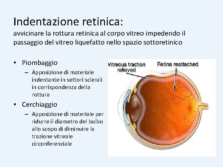 Indentazione retinica: avvicinare la rottura retinica al corpo vitreo impedendo il passaggio del vitreo