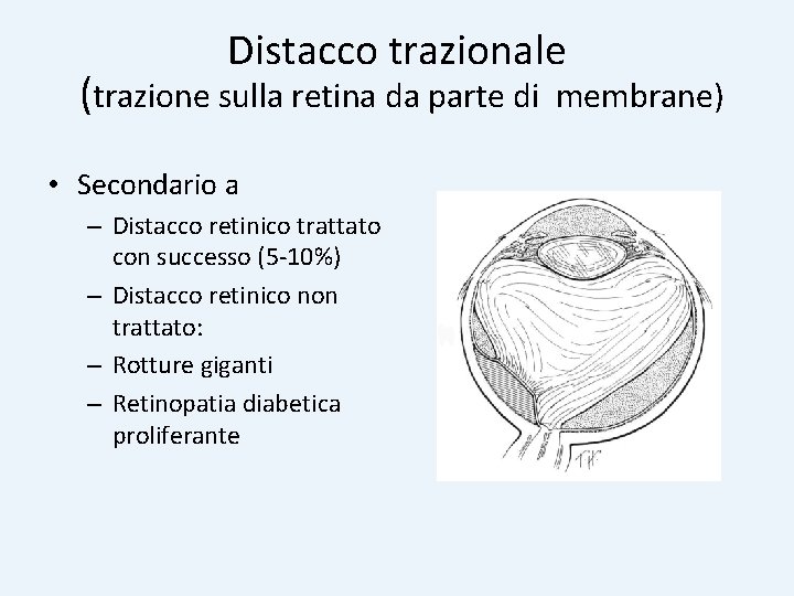 Distacco trazionale (trazione sulla retina da parte di • Secondario a – Distacco retinico