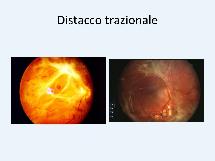 Distacco trazionale 