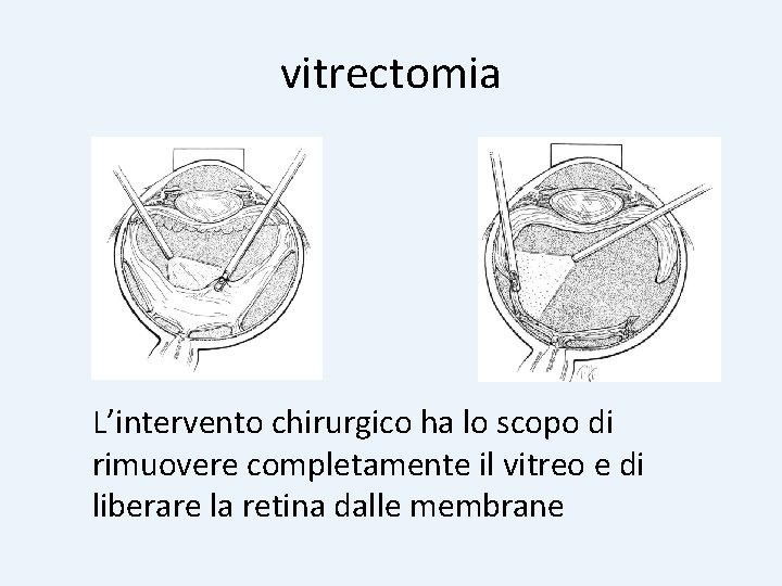 vitrectomia L’intervento chirurgico ha lo scopo di rimuovere completamente il vitreo e di liberare