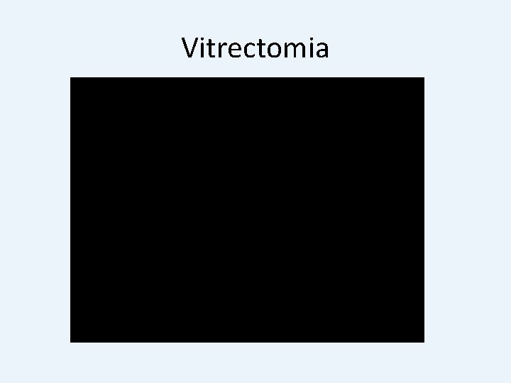 Vitrectomia 
