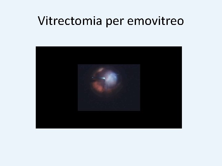 Vitrectomia per emovitreo 