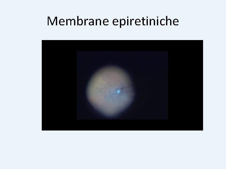 Membrane epiretiniche 