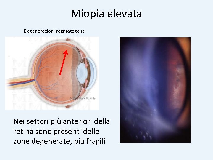 Miopia elevata Degenerazioni regmatogene Nei settori più anteriori della retina sono presenti delle zone