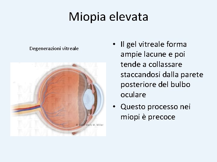 Miopia elevata Degenerazioni vitreale • Il gel vitreale forma ampie lacune e poi tende