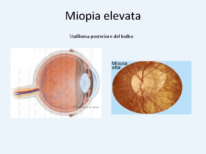 Miopia elevata Stafiloma posteriore del bulbo 