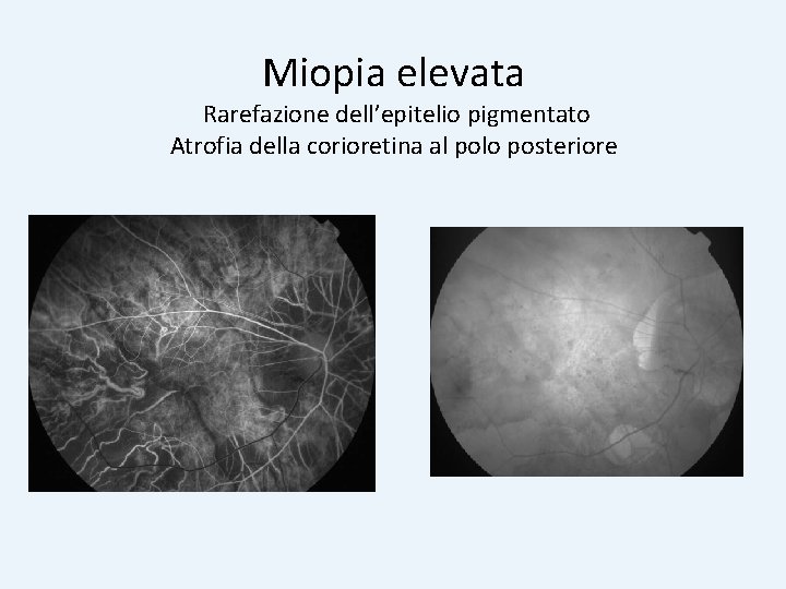 Miopia elevata Rarefazione dell’epitelio pigmentato Atrofia della corioretina al polo posteriore 