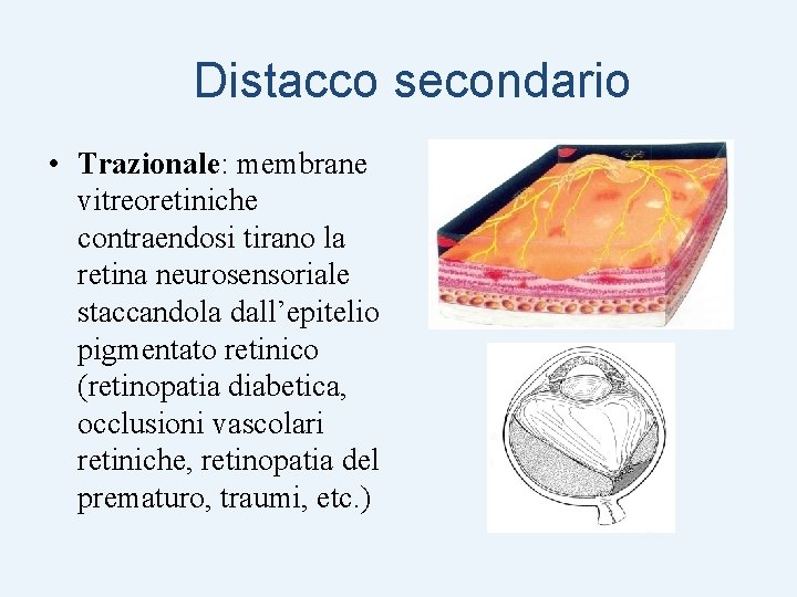 Distacco secondario • Trazionale: membrane vitreoretiniche contraendosi tirano la retina neurosensoriale staccandola dall’epitelio pigmentato