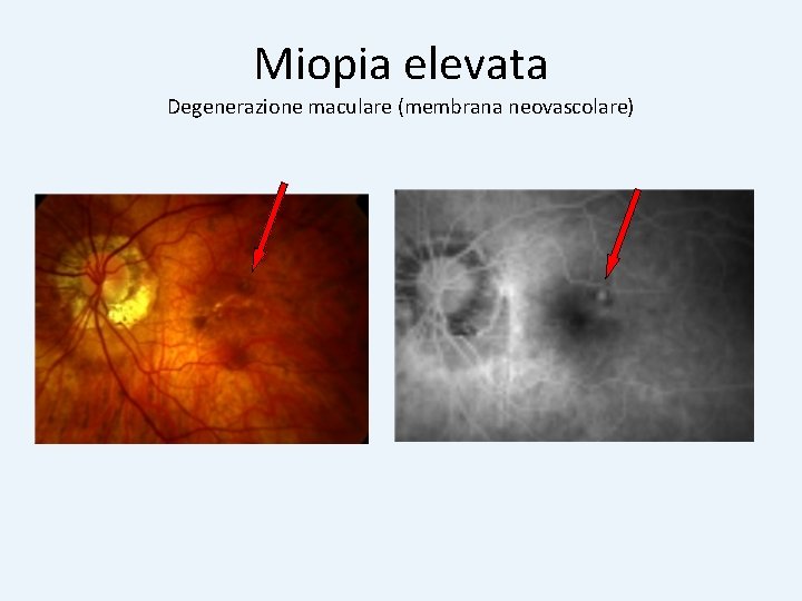 Miopia elevata Degenerazione maculare (membrana neovascolare) 