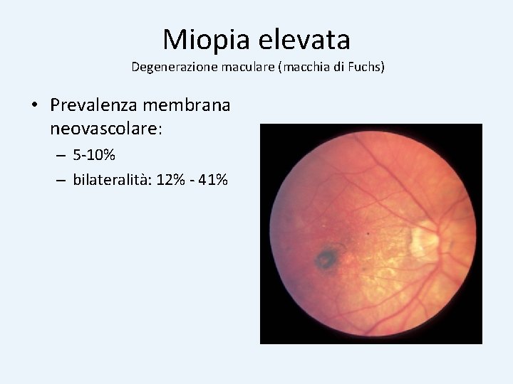 Miopia elevata Degenerazione maculare (macchia di Fuchs) • Prevalenza membrana neovascolare: – 5 -10%