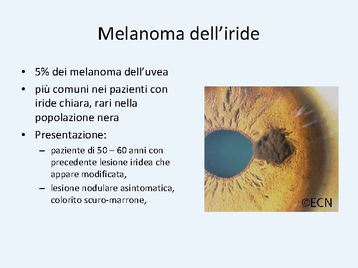 Melanoma dell’iride • 5% dei melanoma dell’uvea • più comuni nei pazienti con iride