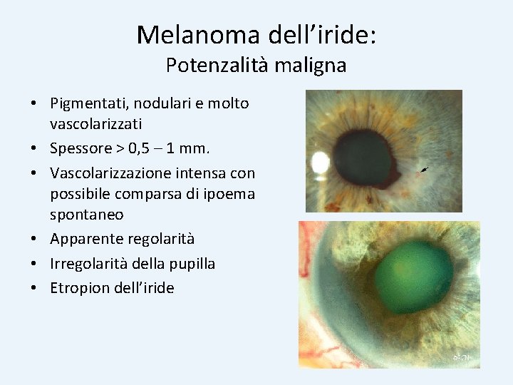 Melanoma dell’iride: Potenzalità maligna • Pigmentati, nodulari e molto vascolarizzati • Spessore > 0,