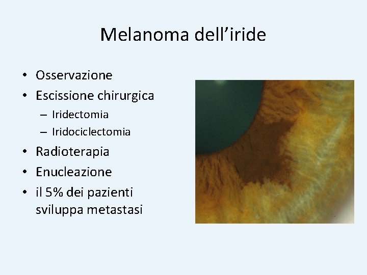 Melanoma dell’iride • Osservazione • Escissione chirurgica – Iridectomia – Iridociclectomia • Radioterapia •