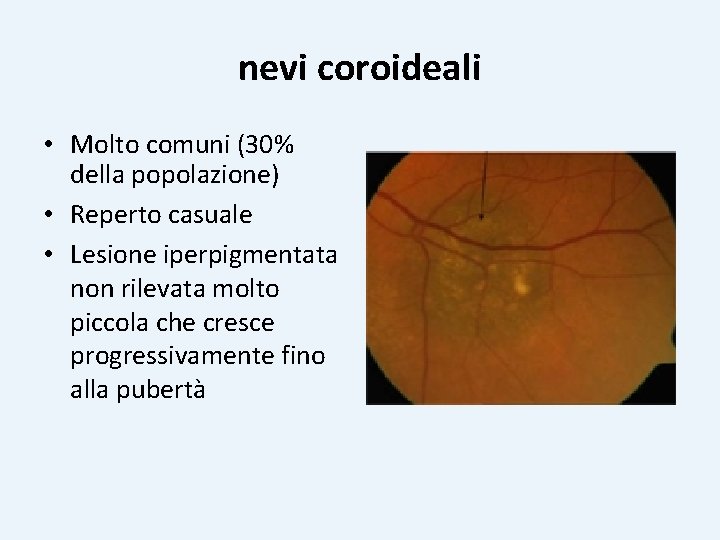 nevi coroideali • Molto comuni (30% della popolazione) • Reperto casuale • Lesione iperpigmentata