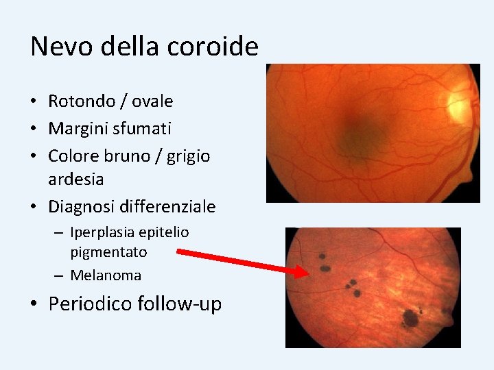 Nevo della coroide • Rotondo / ovale • Margini sfumati • Colore bruno /