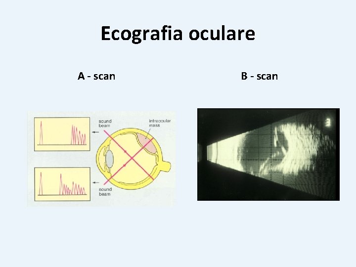 Ecografia oculare A - scan B - scan 