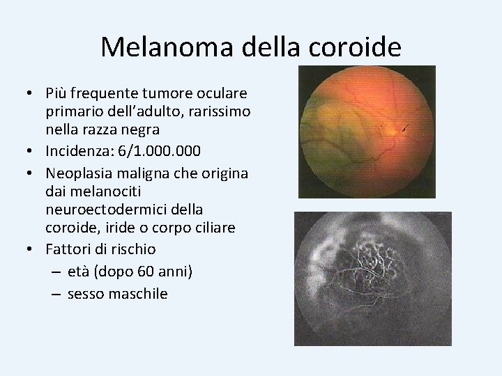 Melanoma della coroide • Più frequente tumore oculare primario dell’adulto, rarissimo nella razza negra