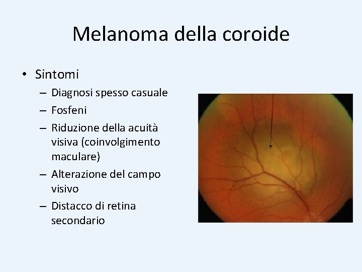 Melanoma della coroide • Sintomi – Diagnosi spesso casuale – Fosfeni – Riduzione della