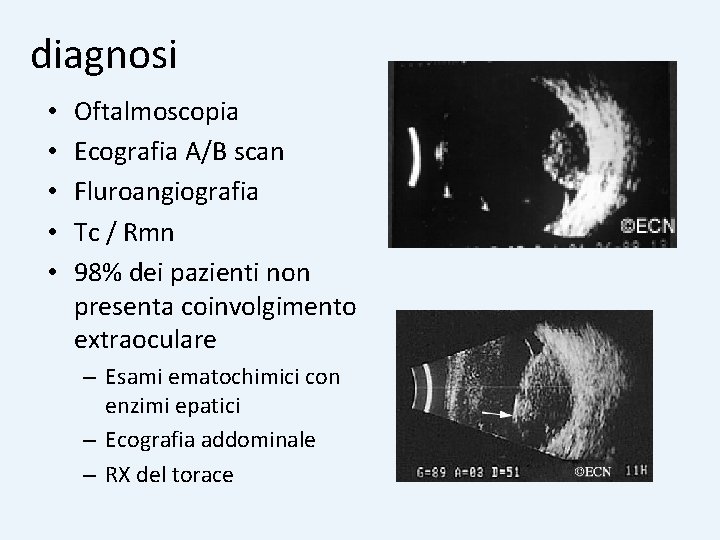 diagnosi • • • Oftalmoscopia Ecografia A/B scan Fluroangiografia Tc / Rmn 98% dei