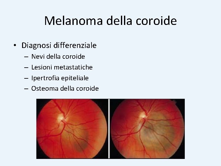 Melanoma della coroide • Diagnosi differenziale – – Nevi della coroide Lesioni metastatiche Ipertrofia