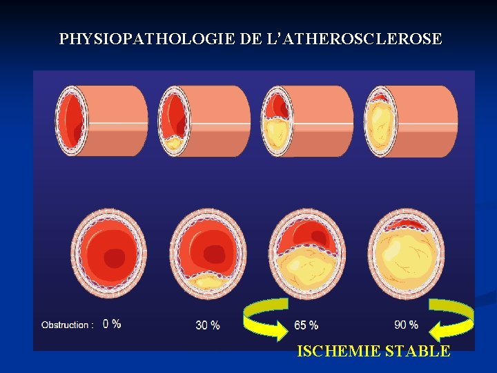 PHYSIOPATHOLOGIE DE L’ATHEROSCLEROSE ISCHEMIE STABLE 