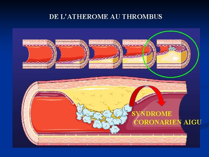 DE L’ATHEROME AU THROMBUS SYNDROME CORONARIEN AIGU 
