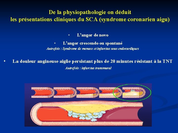 De la physiopathologie on déduit les présentations cliniques du SCA (syndrome coronarien aigu) •