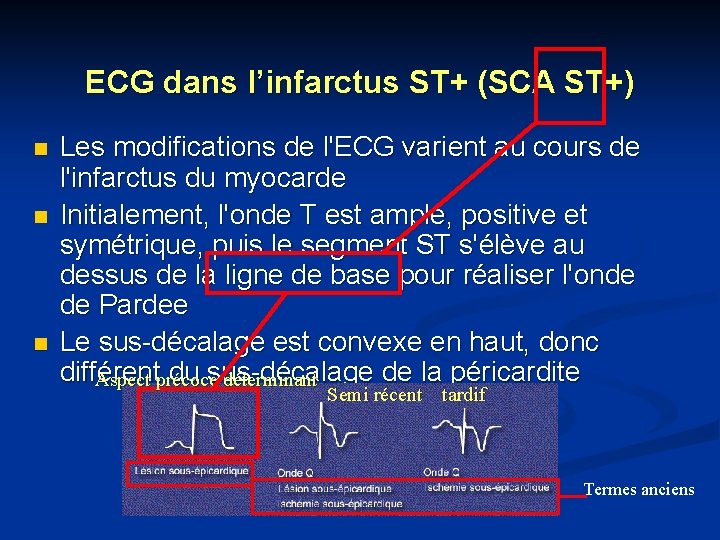 ECG dans l’infarctus ST+ (SCA ST+) n n n Les modifications de l'ECG varient
