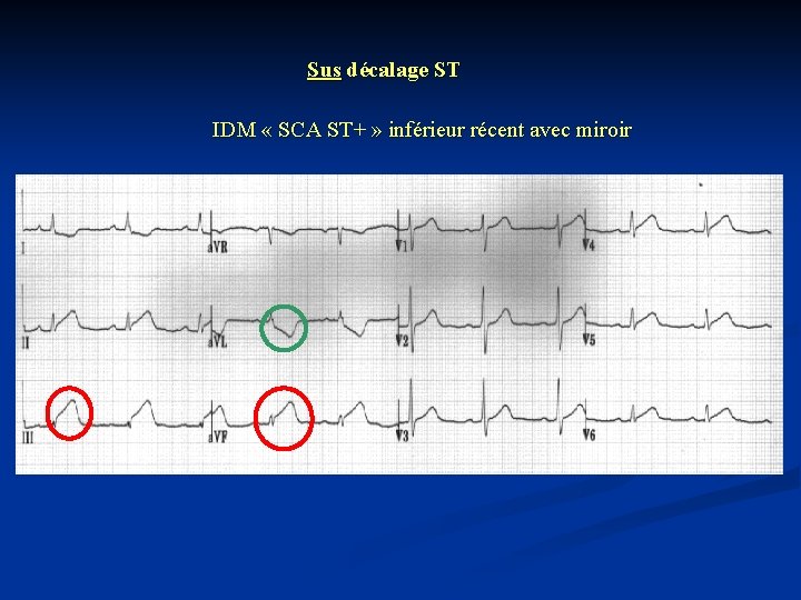 Sus décalage ST IDM « SCA ST+ » inférieur récent avec miroir 
