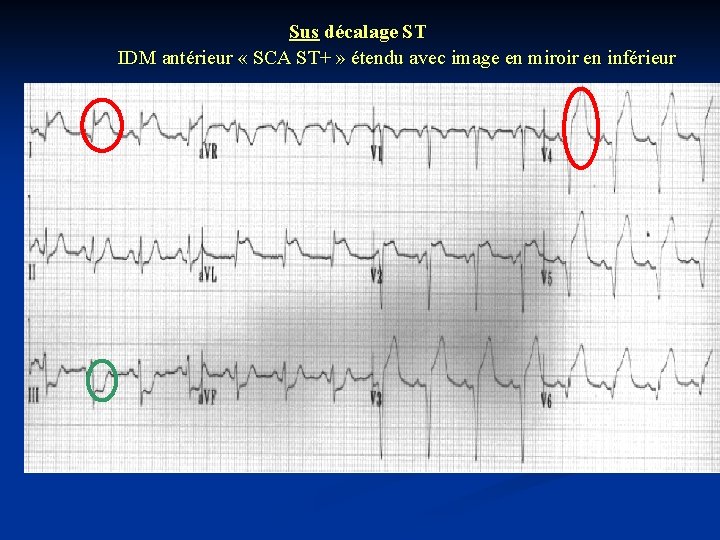Sus décalage ST IDM antérieur « SCA ST+ » étendu avec image en miroir