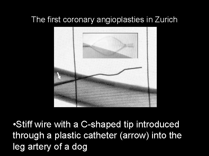The first coronary angioplasties in Zurich • Stiff wire with a C-shaped tip introduced