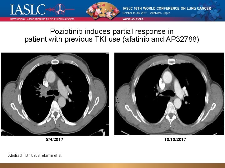 Poziotinib induces partial response in patient with previous TKI use (afatinib and AP 32788)