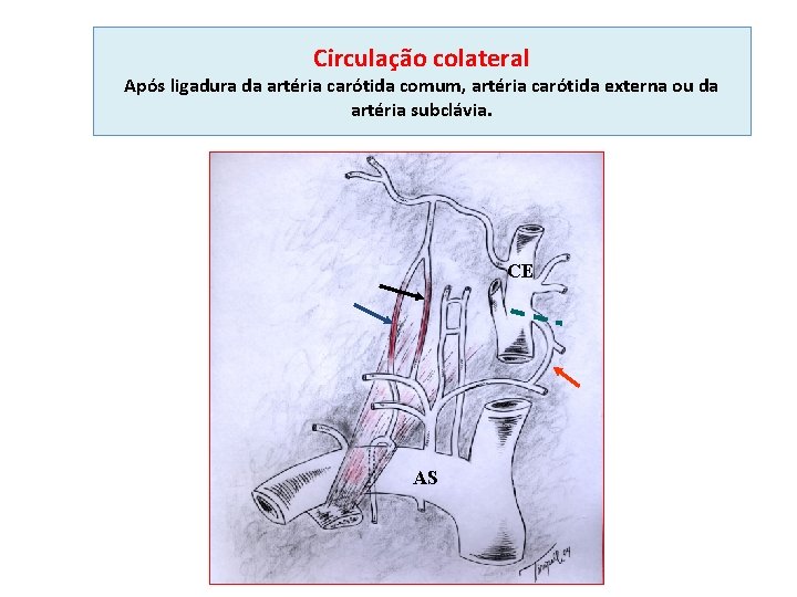 Circulação colateral Após ligadura da artéria carótida comum, artéria carótida externa ou da artéria