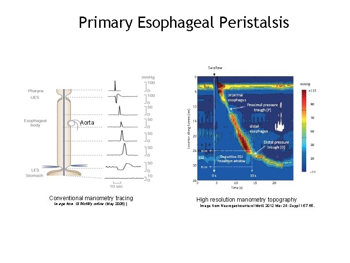 Primary Esophageal Peristalsis Aorta Conventional manometry tracing Image from GI Motility online (May 2006)