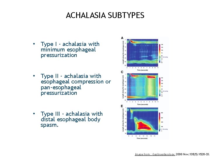 ACHALASIA SUBTYPES • Type I - achalasia with minimum esophageal pressurization • Type II