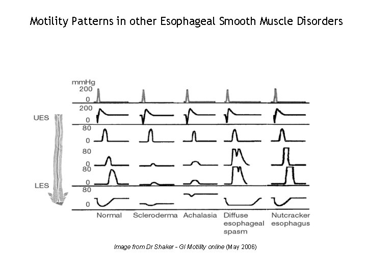 Motility Patterns in other Esophageal Smooth Muscle Disorders Image from Dr Shaker - GI