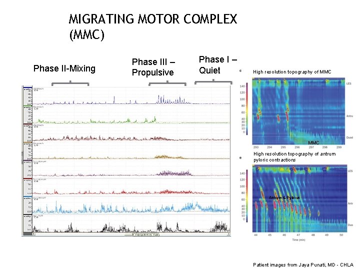 MIGRATING MOTOR COMPLEX (MMC) Phase II-Mixing Phase III – Propulsive Phase I – Quiet