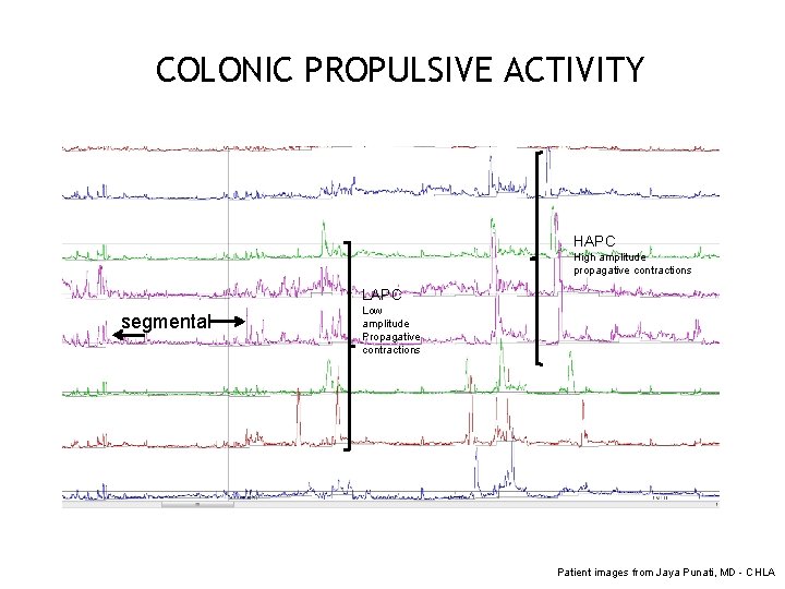 COLONIC PROPULSIVE ACTIVITY HAPC High amplitude 100 mm Hg propagative contractions LAPC segmental Low